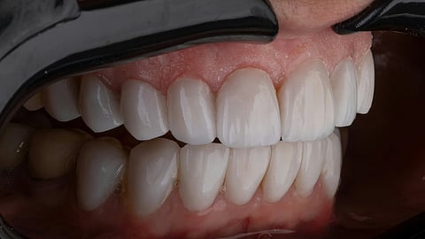 An image of  a dental procedure.