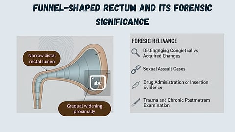 Diagram of funnel-shaped rectum showing distal narrowing and gradual proximal widening and forensic relevance.