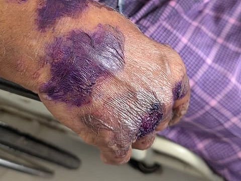 An image of a patient's hand full of blisters, indicating pemphigus vulgaris. Pemphigus vulgaris skin blister autoimmune disease