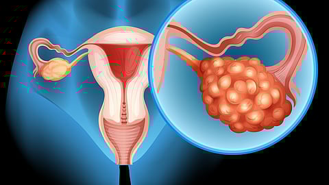 Illustration of ovarian cancer by using graphical ovary in pink color having blue background.