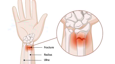 A medical illustration of a wrist with a broken bone inside.