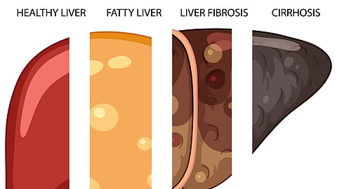 A medical illustration showing different stages of fatty liver disease.