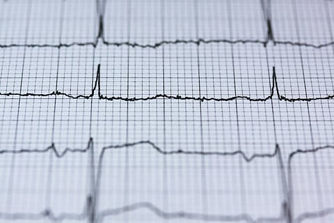 An image of an ECG.