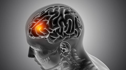 Male medical figure with front of the brain highlighted indicating a a lesion in an area.
