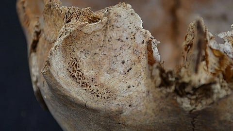 Cribra Orbitalia in a young child from the medieval site of Helgeandsholmen, Stockholm, Sweden.