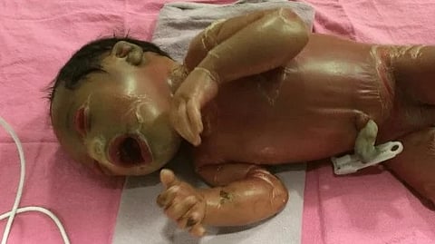 Image of a baby suffering from Collodion Baby Syndrome lying over a pink sheet. 