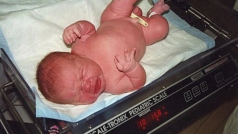 Image of a newborn suffering from Macrosomia.
