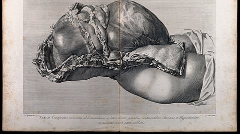 Dissection of the pregnant female abdomen, showing the skin peeled away to reveal the swollen uterus and the viscera, side view.