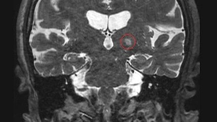 Image of a scan of a brain tumor.