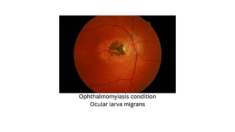 An image of ocular larva.