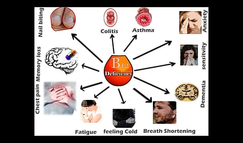 Diagram showing various symptoms of Vitamin B12 deficiency