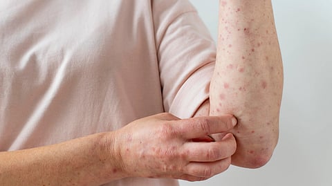 An image of  a person with chickenpox rash on his arms.