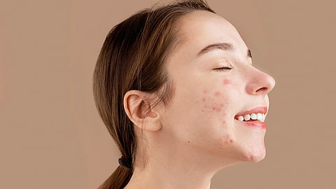 An image of a woman with acne.