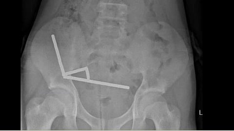 Image of CT scan showing 80-100 magnets in the abdomen of a 13 year old boy.