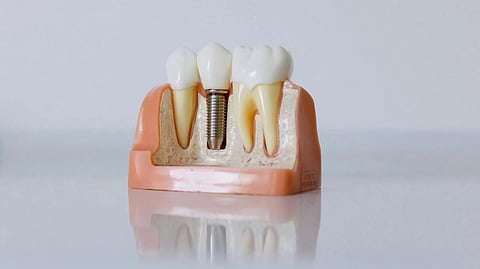 An image of dental implants.