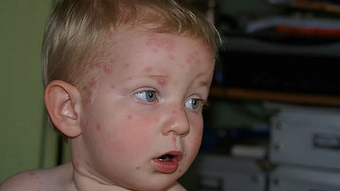  A young boy with a chickenpox rash on his face, displaying red spots and irritation.