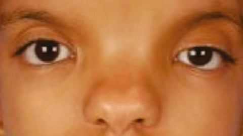 Orbital hypertelorism refers to a wider-than-usual distance between the bony eye sockets.