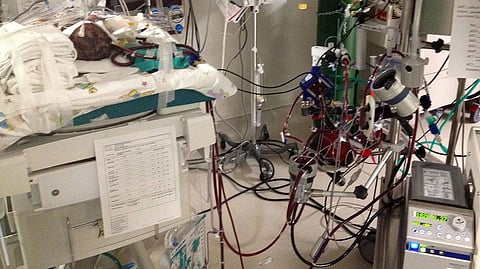 An infant is hooked into an ECMO machine. the ECMO machine with lots of wires and pipes is visible too. 
