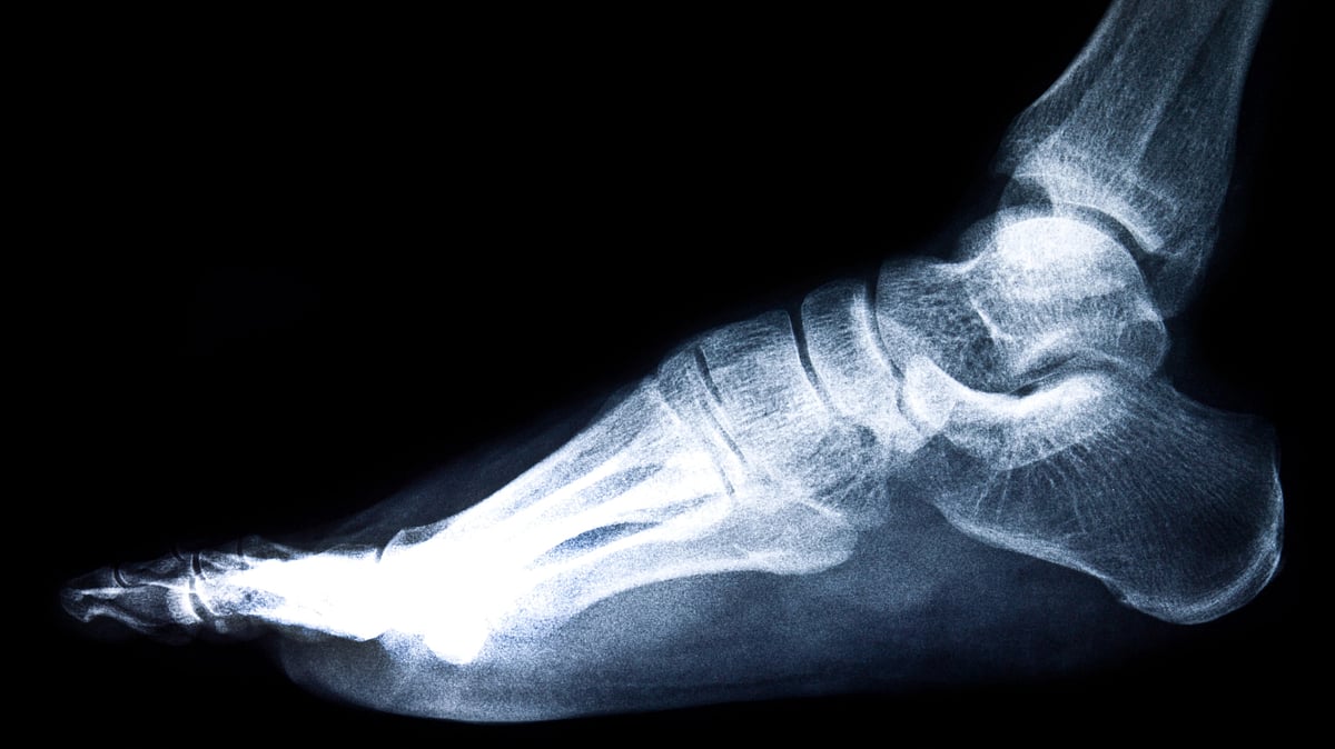 PGIMER Doctor Develops Patel–Dhillon Classification for Ankle Malunion