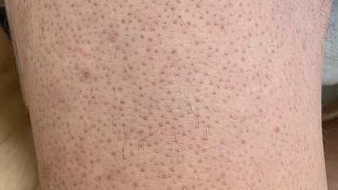 Keratosis Pilaris on Lower Extremity
