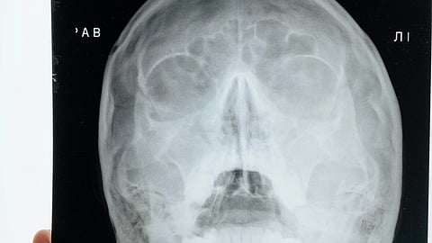 A person holds an x-ray image of a brain, displaying the intricate bone structure clearly.