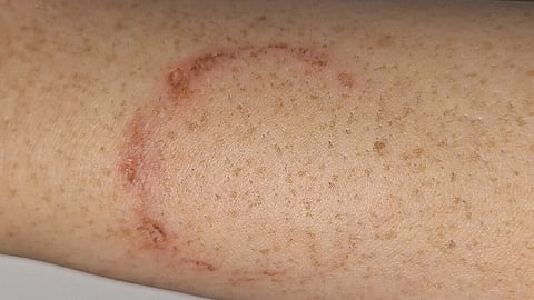 An image of a human bite mark on an arm.