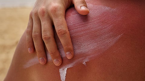Image of a person applying sunscreen on his back.