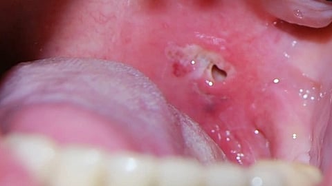 A pus-filled area near the tonsil of   an infected individual.