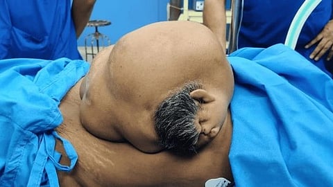 Heteropagus twin with visible scalp hairs and other facial features on the abdomen of the patient. 