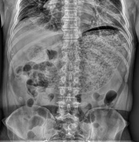 Plain abdominal X-ray reveals a large amount of material in the stomach, suggesting severe gastric hypomotility.