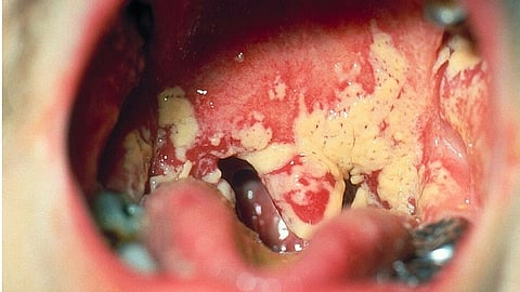 An image of oral thrush infection.