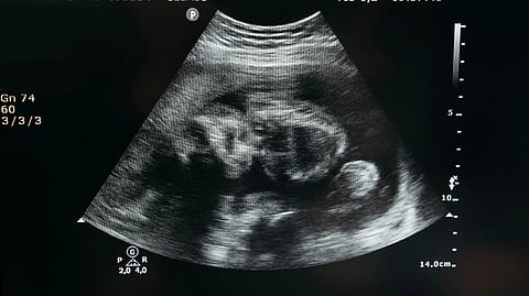 Ultrasound image showing a black and white sonogram of a fetus in the womb.
