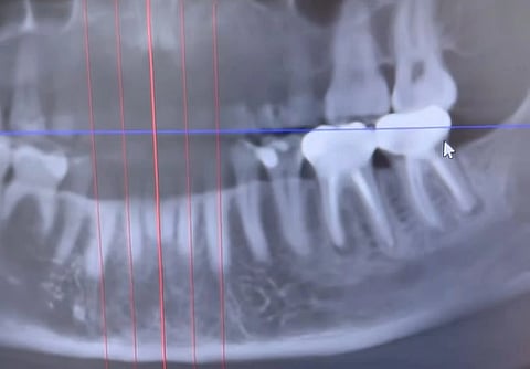 A screengrab of the oral x-ray from the viral video showing the two root canal treated teeth