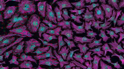 An image of cancer cells, showing vivid magenta cytoskeletons.