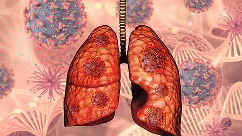 An image of lungs with viral infection. Lungs show red virus-like spots, surrounded by enlarged viruses.