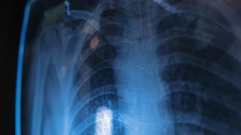 Image of an X-ray of lungs.