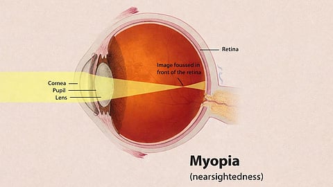 A Diagram of Myopia in the human eye.