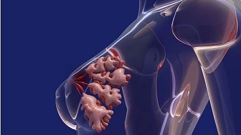 An image of cancer cells in breast cancer.