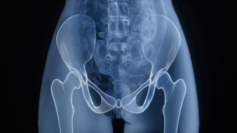 An image of a person’s pelvic X-ray showing the hip bones, spine, and upper leg bones.