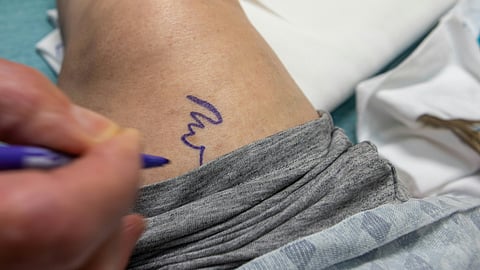 Marking knee with a blue marker.