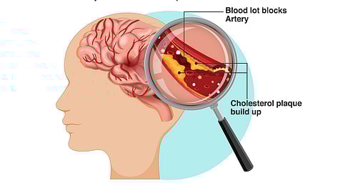 A poster explaining what ischemic stroke with a medical illustration of a blood vessel is and showing plaque buildup. 