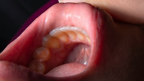 An image of a person's mouth featuring a missing tooth, representing dental health challenges associated with dry mouth conditions.