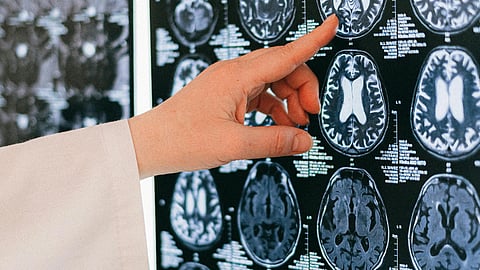 Doctor's finger pointing at brain scan