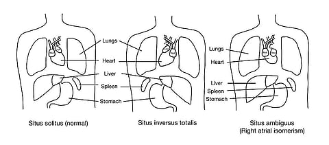 Right atrial isomerism is a specific subtype of situs ambiguus, used here to demonstrate an example of what situs ambiguus can look like. RAA = right atrial appendage; LAA = left atrial appendage