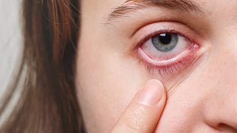 Close-up of a person's eye with red, irritated skin and visible dryness.