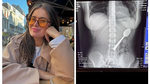 Collage showing portrait Reymy Amelinckx and the X-ray of the chest showing spoon. 