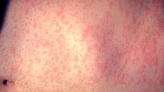 Skin close-up showing a red, blotchy rash characteristic of measles.