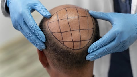 Male going through a hair transplant