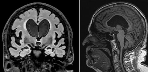 Two MRI scans for Dick Nash show some of the classic signs of NPH. 