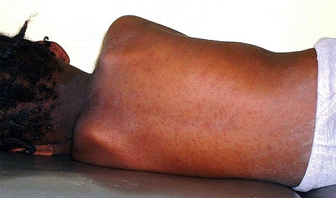 A child with measles rash on their back. 